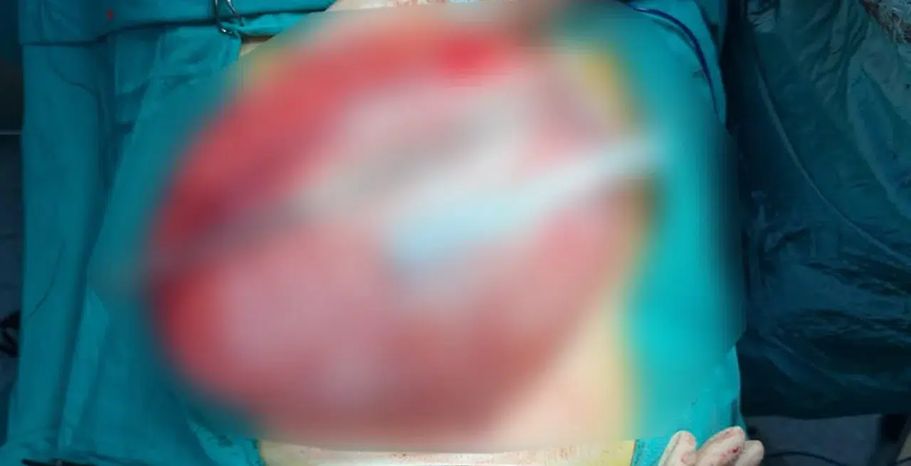 Bolu'da kilo vermek için hastaneye giden öğrencinin karnından 3,5 kiloluk kist çıktı