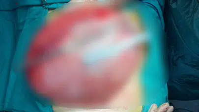 Bolu'da kilo vermek için hastaneye giden öğrencinin karnından 3,5 kiloluk kist çıktı