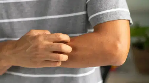 Onkolog Amit Garg uyardı kaşıntı sinsi kanserlerin belirtisi olabilir