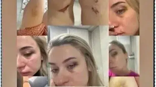 Şiddet mağduru öğretmen, darp izlerini sosyal medyada yayınladı