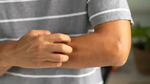 Onkolog Amit Garg uyardı kaşıntı sinsi kanserlerin belirtisi olabilir