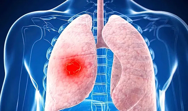 Akciğer Kanserinde Erken Teşhis Devrimi: İdrar Testi Umut Vaat Ediyor