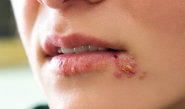 Uçuk deyip geçmeyin, bakın neye sebep oluyor